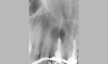 Root canal treatment in Anand                        